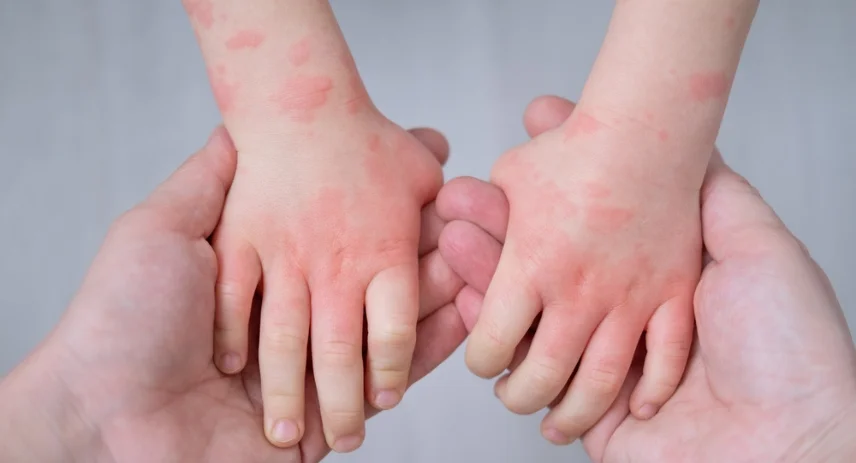 How To Choose The Best Carpet For Allergies